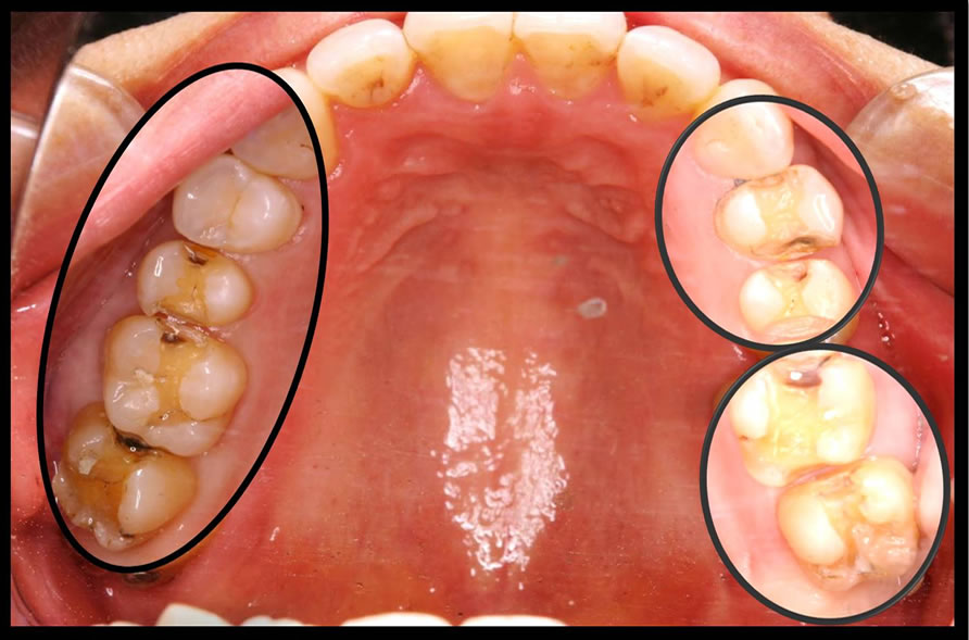 審美歯科の症例2