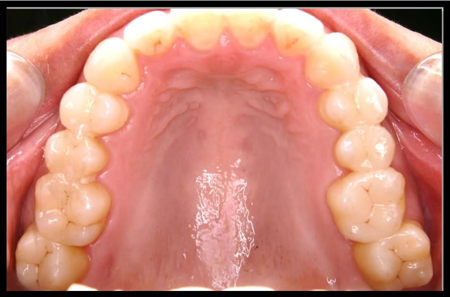 審美歯科の症例3