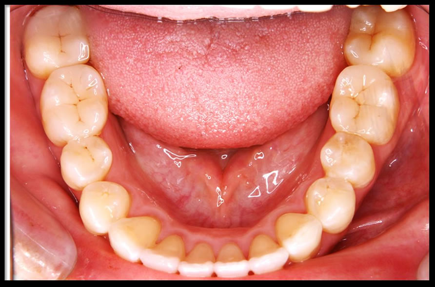 審美歯科の症例1