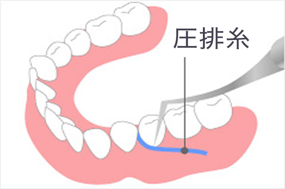 歯肉圧排で良適合の実現