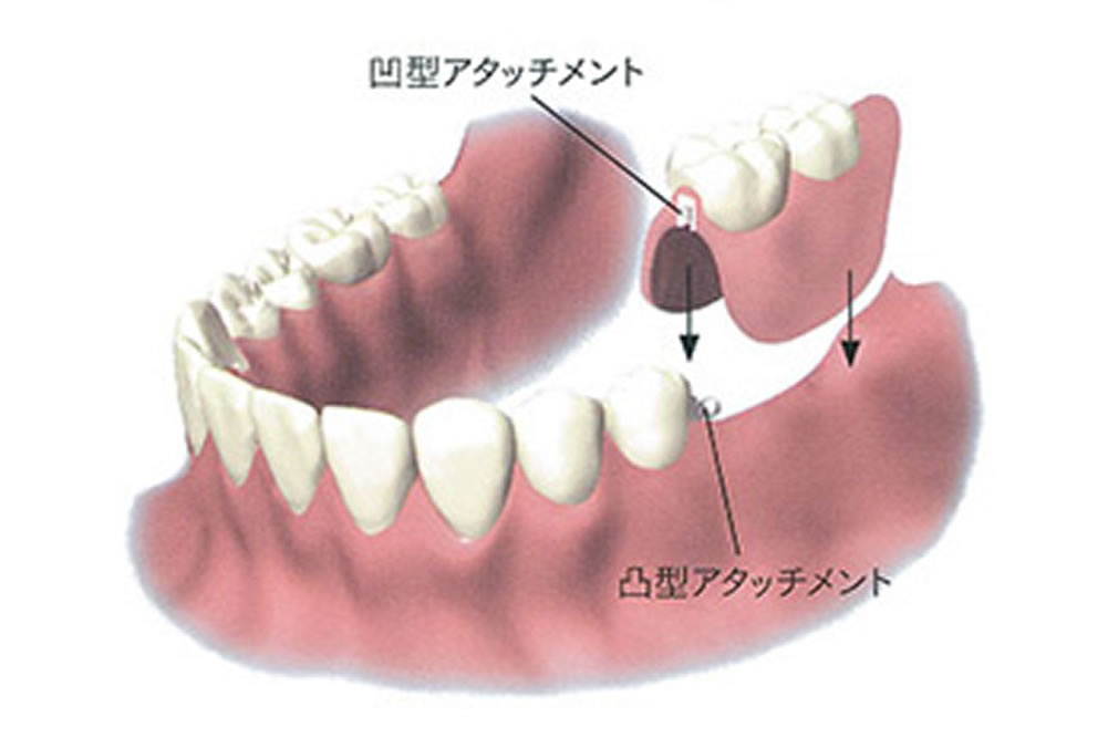 アタッチメント義歯