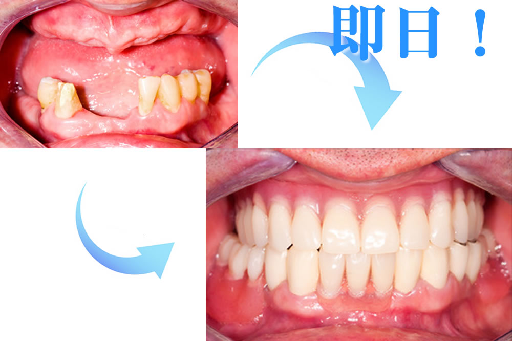 抜歯した日に埋入