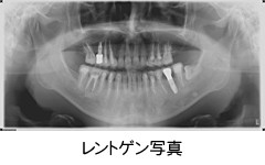 インプラント