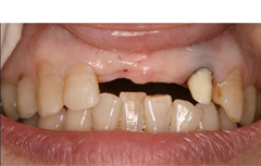 前歯部症例（ノーベルガイド）