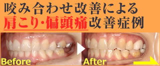 咬み合わせ改善による肩こり 偏頭痛の改善症例 東京世田谷 歯科 歯医者 咬み合わせ改善による肩こり 偏頭痛の改善症例 東京世田谷 歯科 歯医者