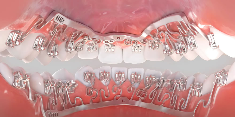 裏側矯正Brava（ブラーバ）