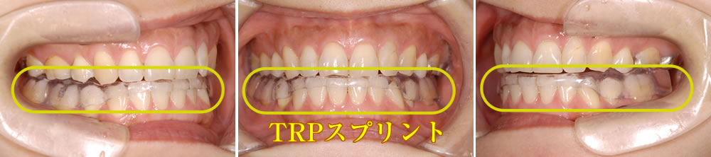 TRPスプリント