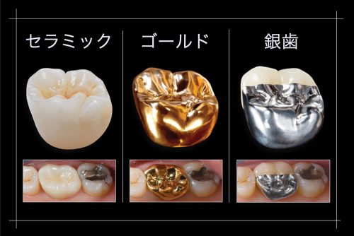 金歯と銀歯の違いについて | 【上野毛駅10分】世田谷中町の歯医者